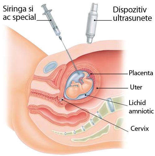 Amniocenteza - beneficii si riscuri