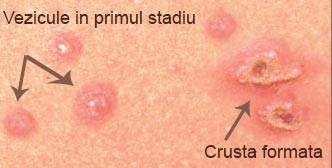 Varicela - varsat de vant eruptie